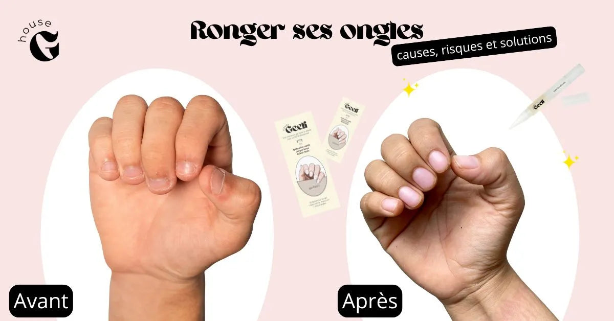 Ronger ses ongles : causes, risques et solutions efficaces
